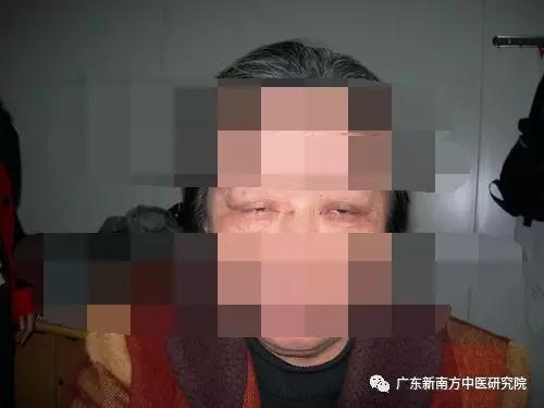 反覆體力不支,警惕重症肌無力